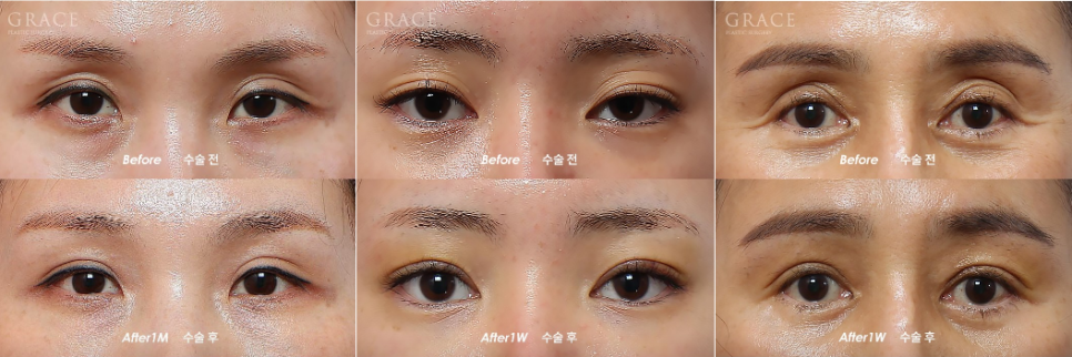 Why Eyelid Hollow Fat Grafting Fails If You Don’t Know This image 4