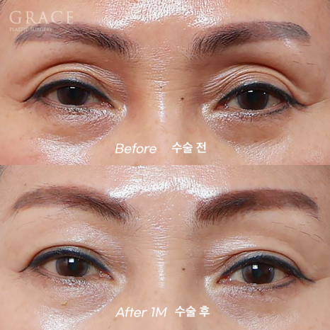 In Your 50s, Restoring a Youthful Look with Before-and-After Eye Surgery and Fat Grafting to the Upper Eyelids, Temples, Under-Eyes, and Above the Brows image 13