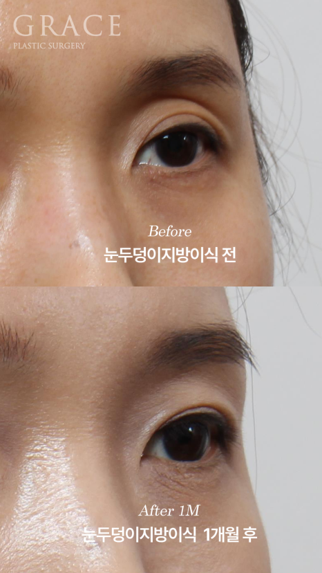 The Key to Improving Sunken Eyelids with Orbital Fat Grafting Is Placement, Not Volume image 3