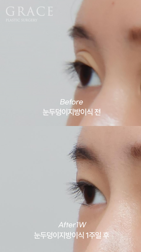 아이홀 꺼짐은 MZ도 예외 없다 눈두덩이 지방이식으로 짝눈교정 관련 이미지 3