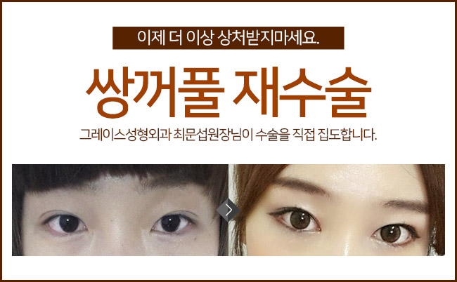 쌍수재수술후기 마지막 수술이 됩니다. 관련 이미지 5