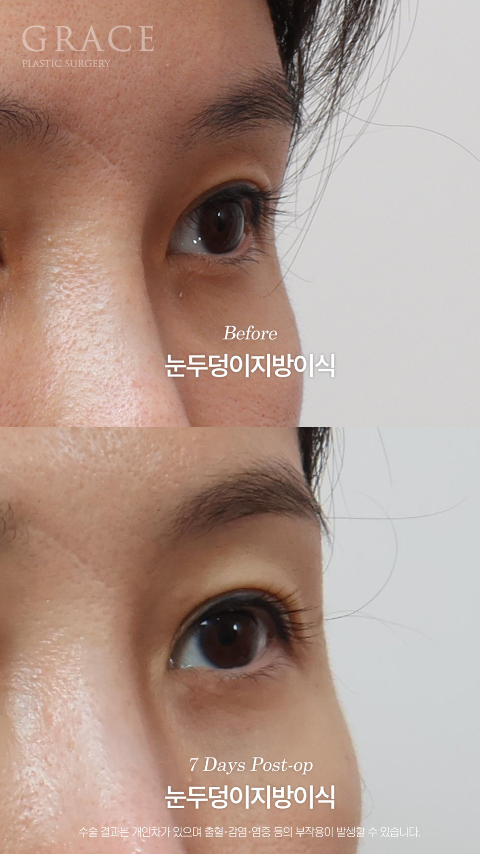 눈두덩이지방이식 하고 일주일 출근 가능한 정도일까? 관련 이미지 5