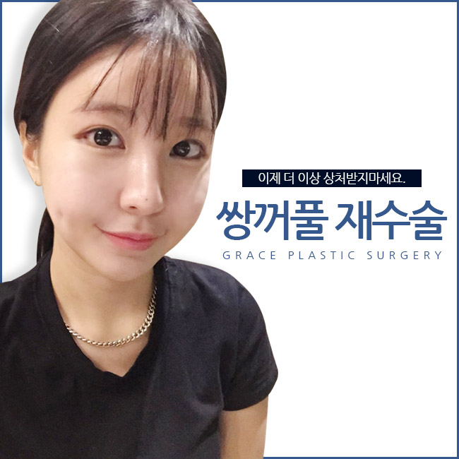 쌍꺼풀재수술하면 그레이스성형외과 최문섭 원장 관련 이미지 1