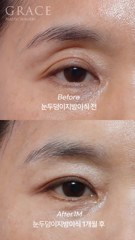 눈꺼풀 지방이식 절개 없이 아이홀 부위를 채우기 관련 이미지 2