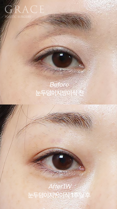 How to Fill Sunken Eyelid Hollows with Fat Grafting (Concerns About Filler Side Effects) image 2