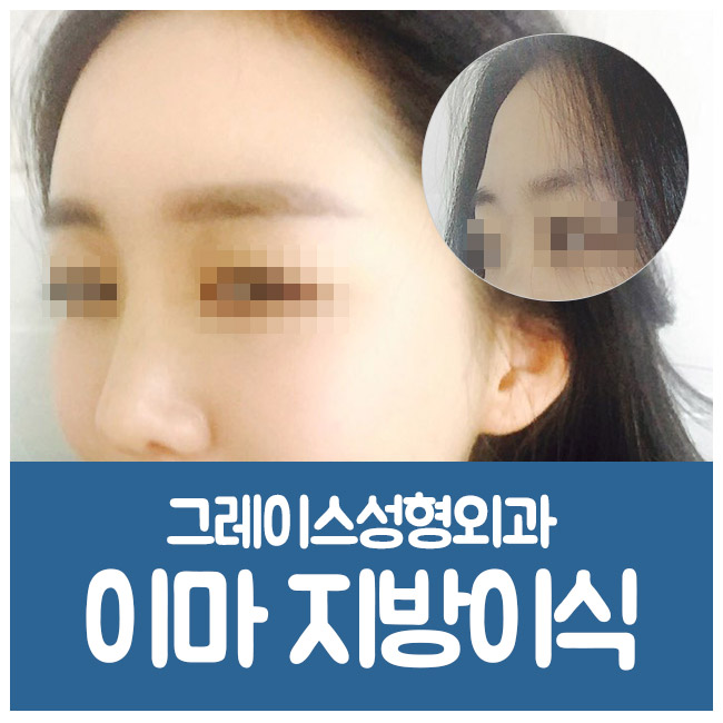푹 꺼진 이마에 생기를 불어넣어 줄, 그레이스성형외과 이마지방이식 관련 이미지 6