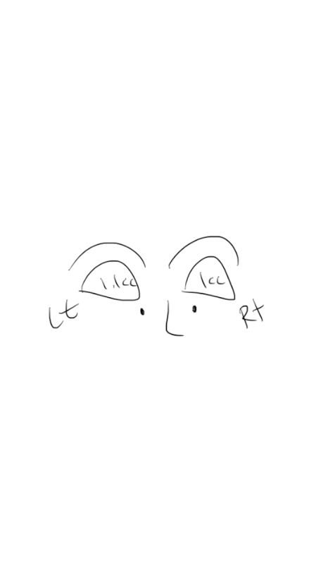 Why Do Hollow Eyelids Occur, and How Can They Be Naturally Improved? (Research Notes from a Doctor Performing Eyelid Fat Grafting) image 2