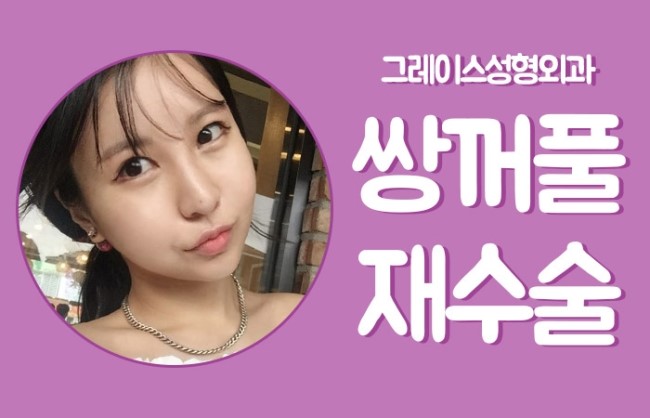 눈재수술의 현명한 선택, 그레이스성형외과 관련 이미지 5