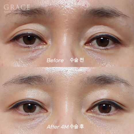 50대 눈꺼풀 지방이식 잘하는곳 염려되는 부작용 걱정까지 관련 이미지 12