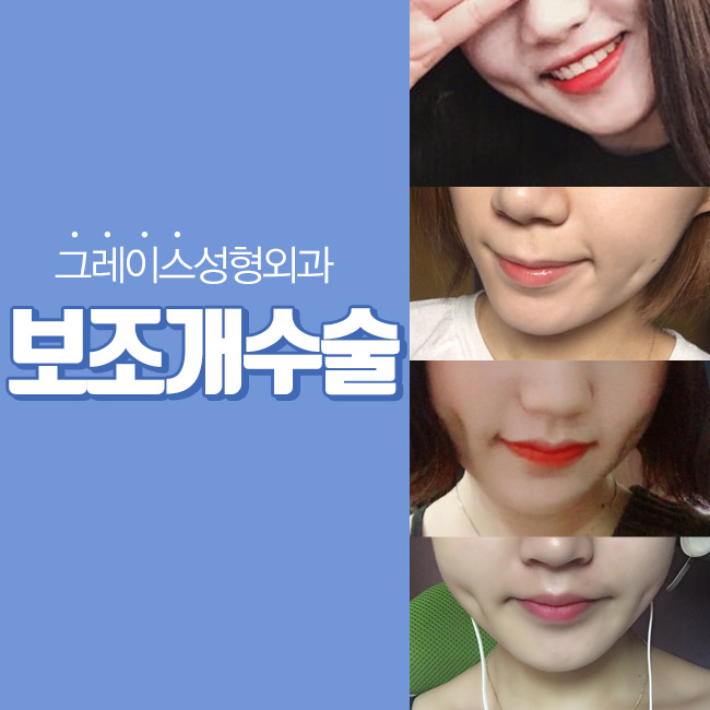 보조개수술은 어디?! 신사역 그래! 그레이스성형외과 관련 이미지 2