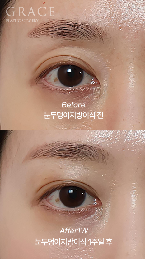 눈꺼풀 지방이식 잘하는 병원 그레이스성형외과 관련 이미지 4