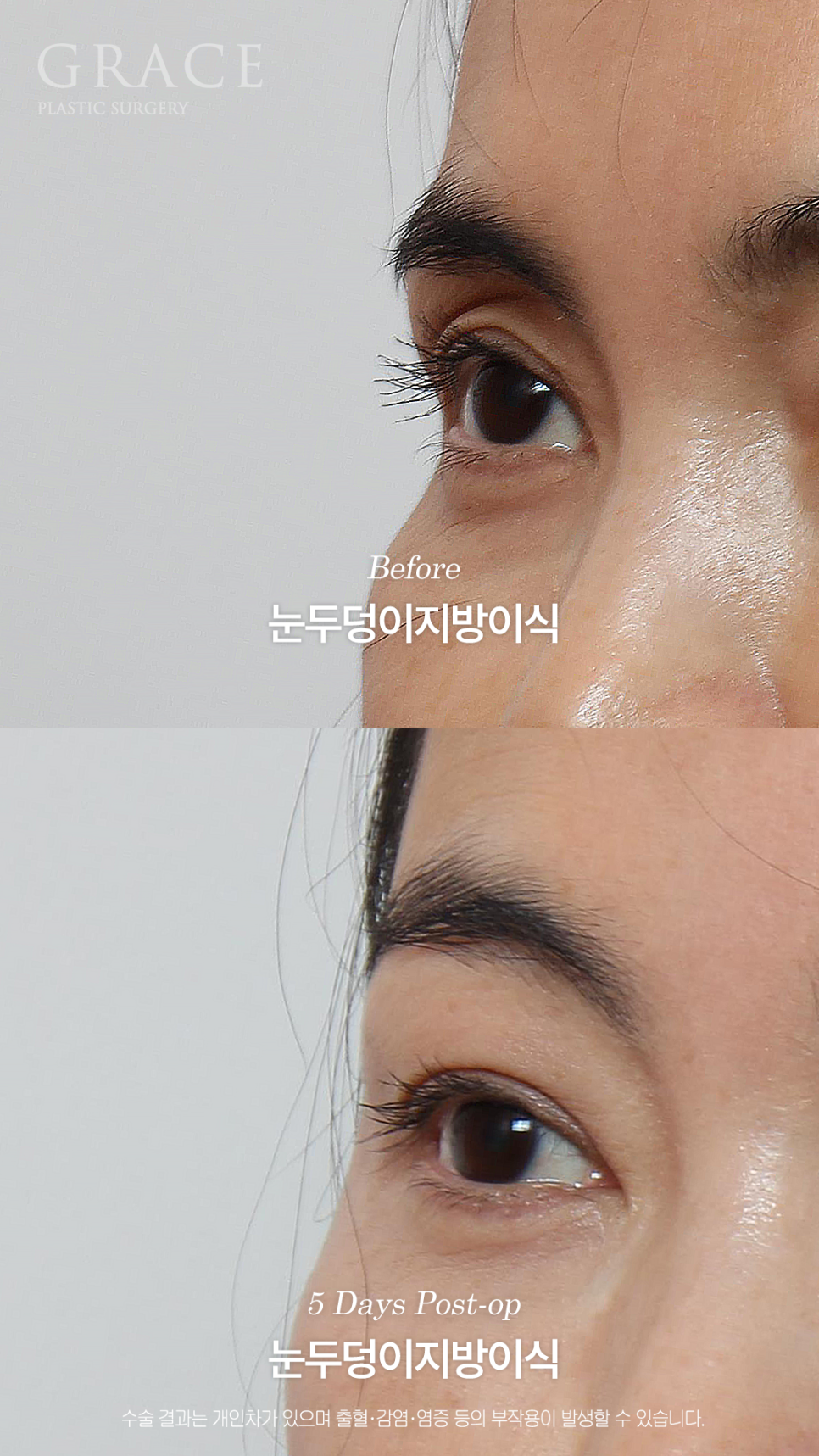 Will a Sunken Upper Eyelid Become Bumpy When You Close Your Eyes After Fat Grafting? image 4
