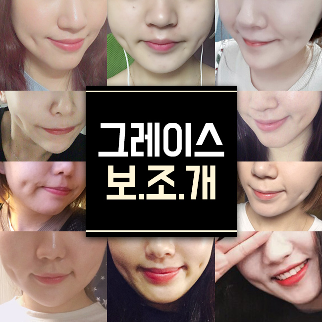 보조개수술 잘하는 곳! 그레이스성형외과 관련 이미지 2