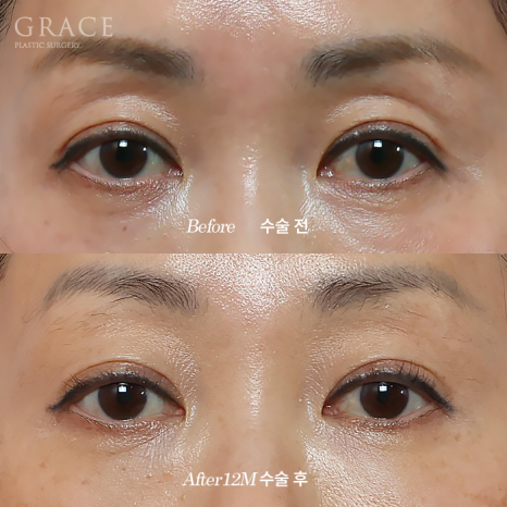 눈두덩이지방이식 유지기간과 볼륨 흡수 부작용? 1주일부터 12개월 경과 기록 관련 이미지 2
