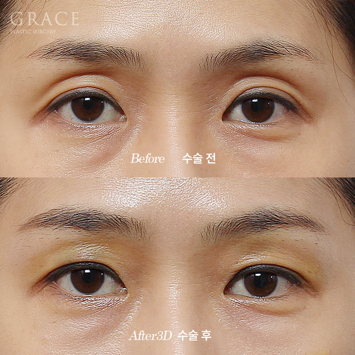 Why It’s Not Always Better Just Because Lower Eyelid Fat Grafting Is Cheap image 9