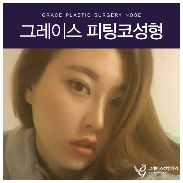 코성형의 고정관념을 깨다! 그레이스성형외과 피팅코 관련 이미지 1