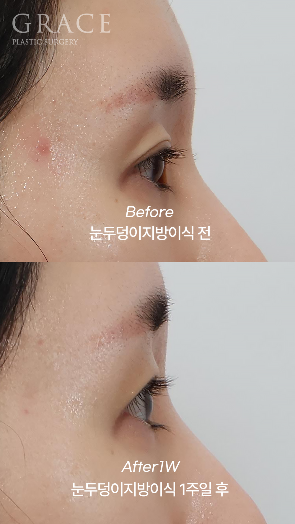 눈두덩이 지방이식 1주일 차 자연스러운 회복 중 관련 이미지 5