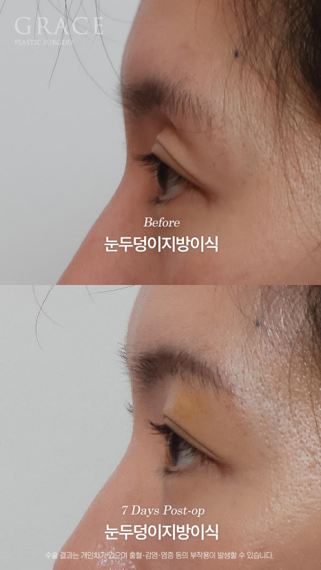Will a Sunken Upper Eyelid Become Bumpy When You Close Your Eyes After Fat Grafting? image 16