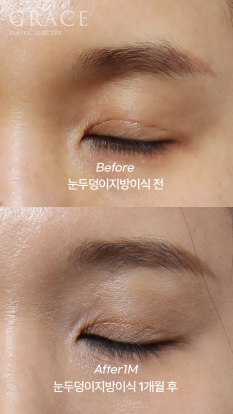 눈두덩이 감으면 울퉁불퉁? 아이홀 지방이식 진실 관련 이미지 2