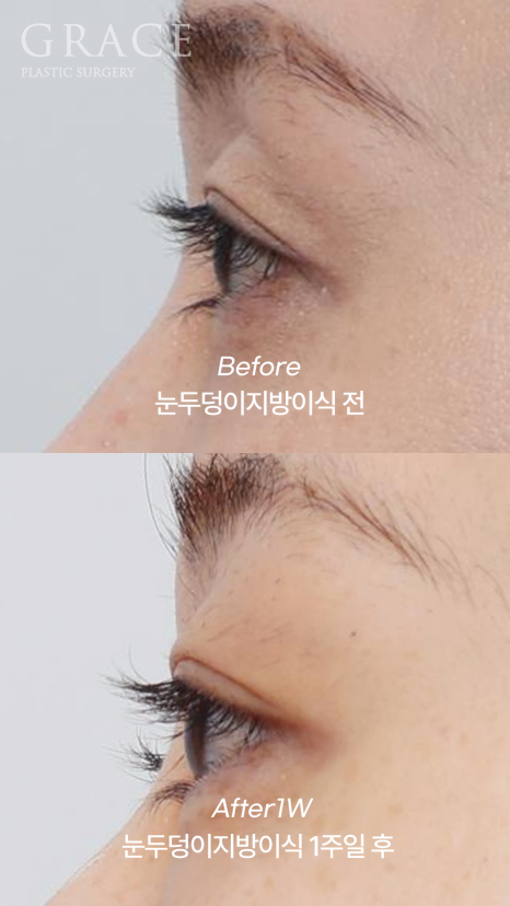 How to Fill Sunken Eyelid Hollows with Fat Grafting (Concerns About Filler Side Effects) image 8