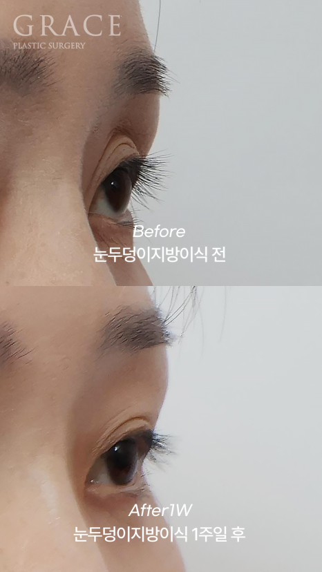 Sunken Upper Eyelids? With Just 0.9cc of Injection for Eye Hollow Fat Grafting image 6