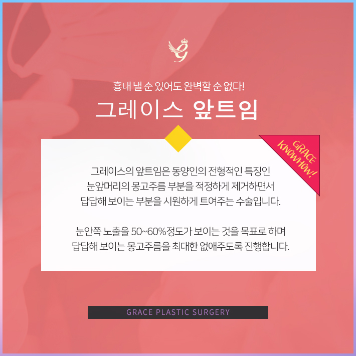 눈앞트임비용 이렇게 알아보세요 관련 이미지 3