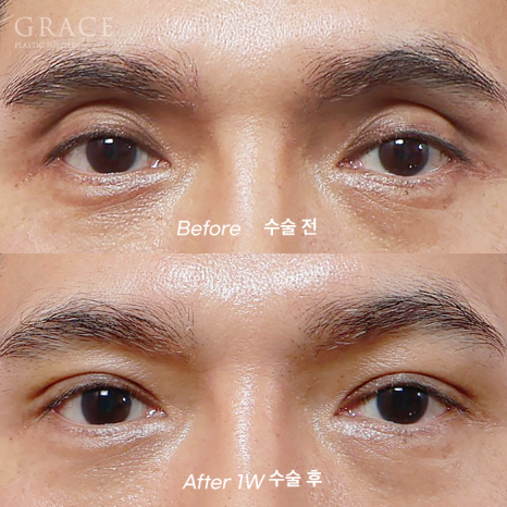 Male Brow Filler? Improvement with Eye-Hole Fat Grafting (Without Worrying About Side Effects, Scars, or Swelling) image 1