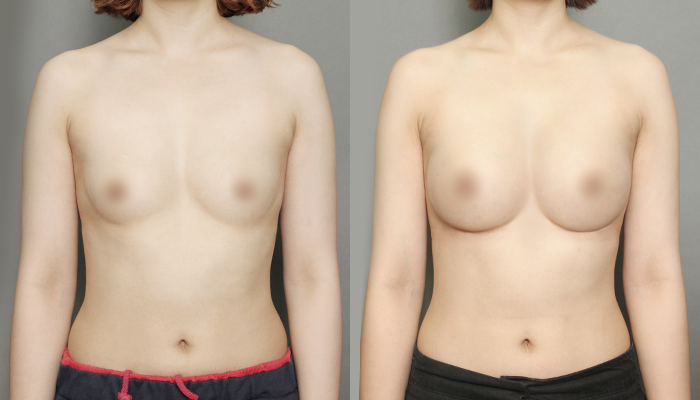 가슴성형 잘하는 곳 근막하 가슴성형의 특징과 멘토 엑스트라 265cc 전후 관련 이미지 1