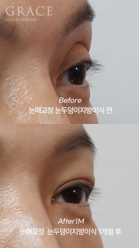 Is Eyelid Fat Grafting in Your 40s Required to Include Ptosis Correction? It Depends on Your Eye Condition image 5
