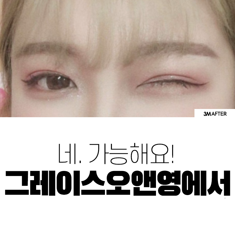 비절개눈매교정 전후 알아보자💕 관련 이미지 3
