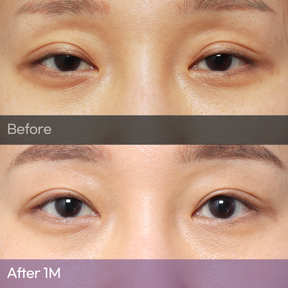 Fatigue-Looking Eyes? Eyelid Fat Grafting image 1