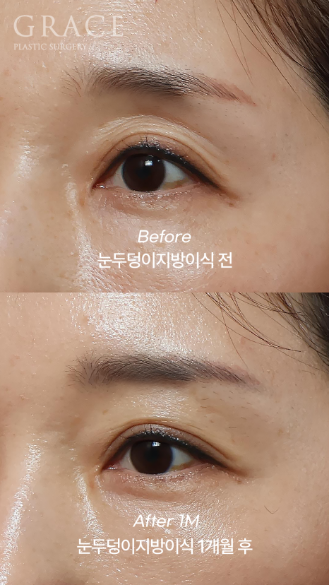 Eyelid Fat Grafting Side Effects? How to Settle In Beautifully Without Lumps image 9