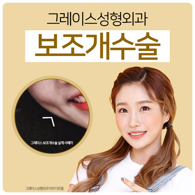 설렘을 주는 미소 보조개수술후기를 알아본다면 관련 이미지 3