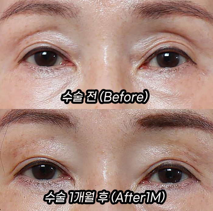 눈두덩이 지방이식으로 젊음을 되찾다: 70대, 40대 시술 전후 비교 관련 이미지 1