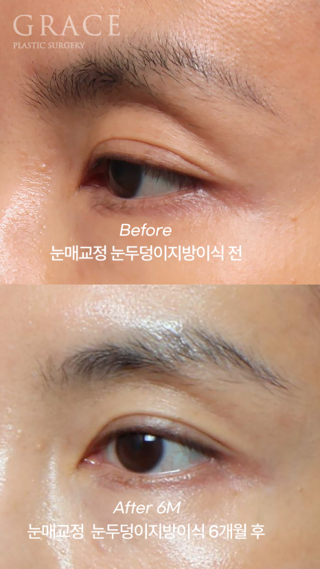 눈꺼풀 지방이식+눈매교정  40대 (눈 감았을 때 눈두덩이 흉터&middot;부작용 체크) 관련 이미지 5
