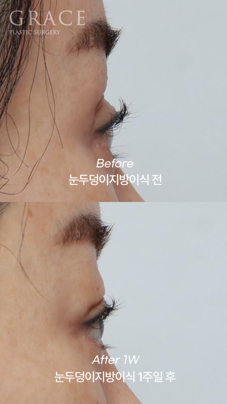 돌출눈성형 전후 움푹 패인 눈꺼풀 지방이식 관련 이미지 11