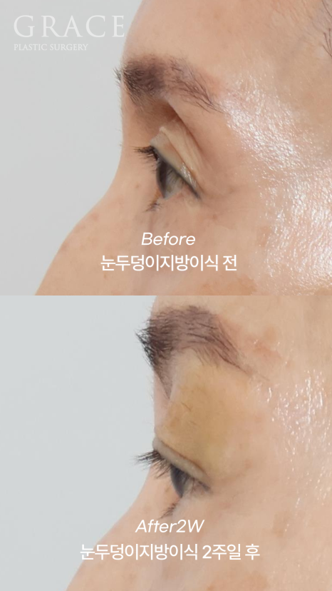 60대 중년 눈두덩이 안와지방이식 1cc 전후 관련 이미지 8