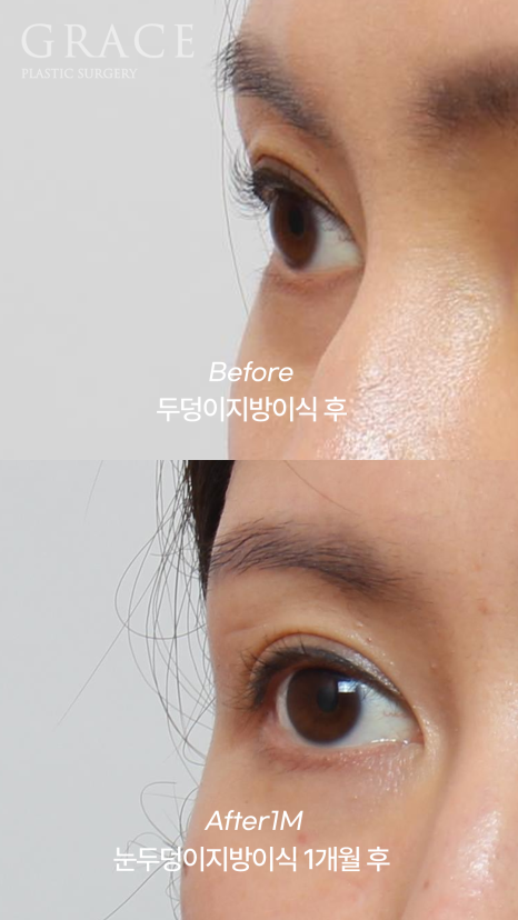 눈밑지방재배치 vs 눈두덩이지방이식｜부작용과 붓기 등 관련 이미지 5