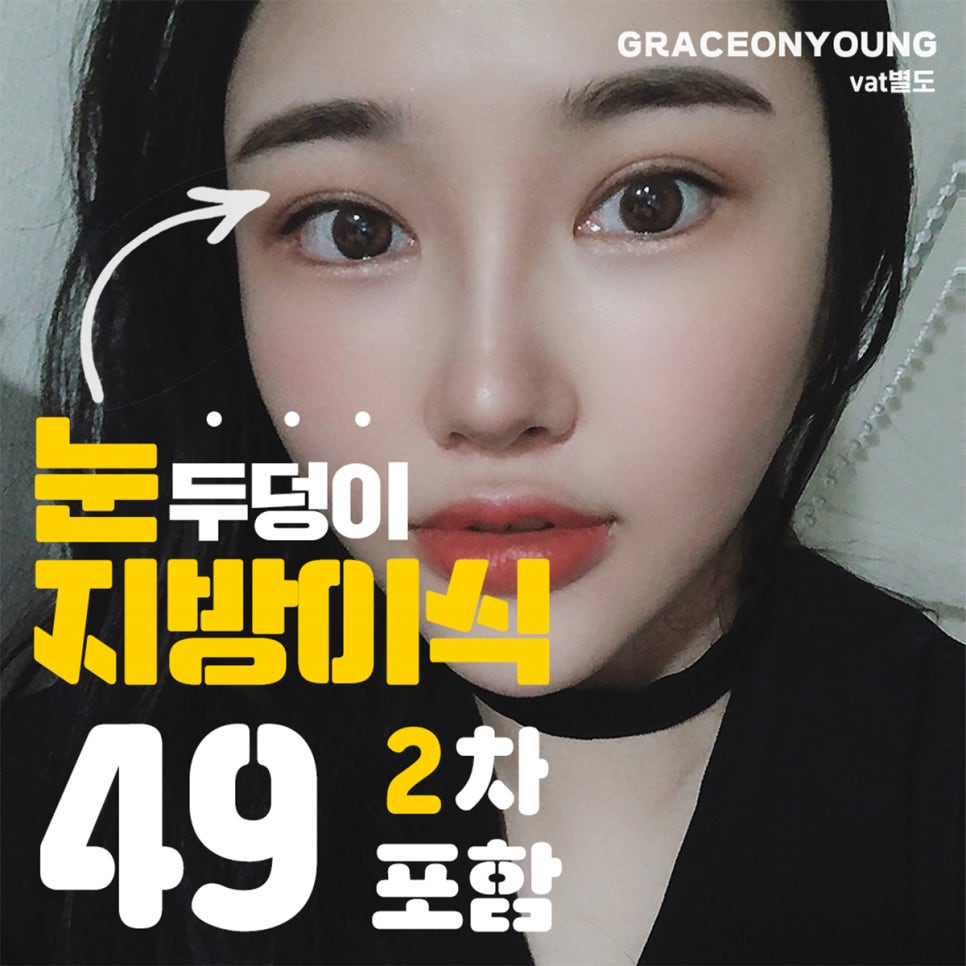 눈꺼짐 지방이식 궁금하시죠? 관련 이미지 2