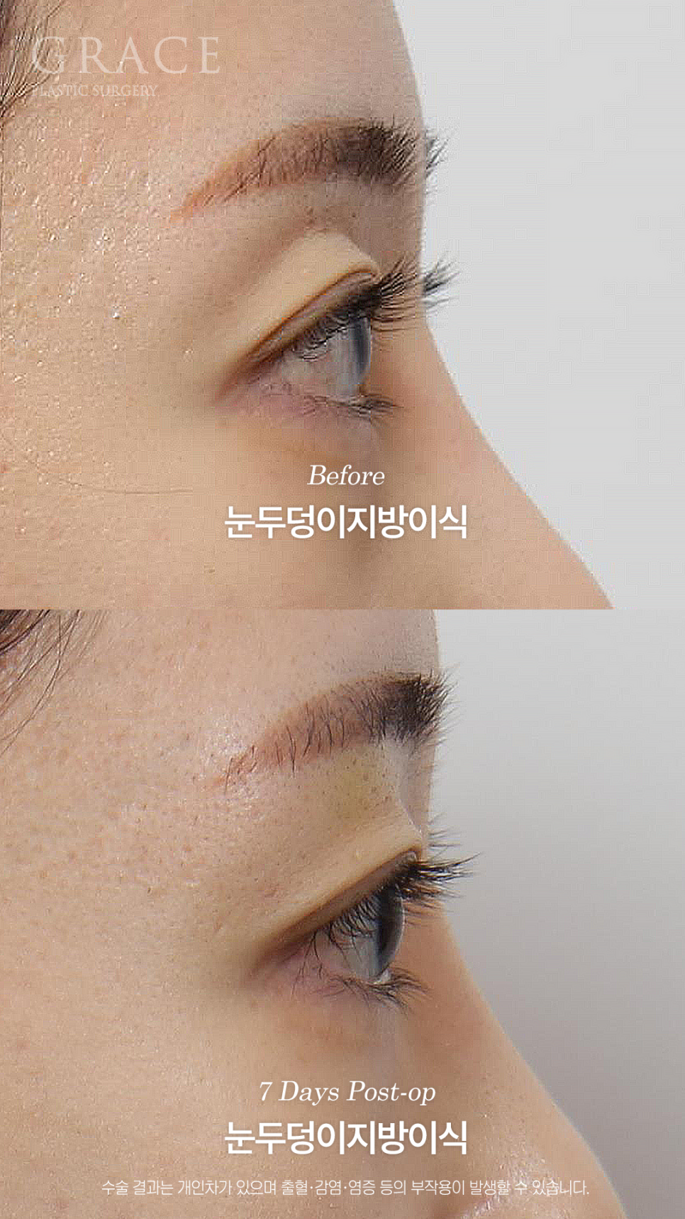 눈두덩이 지방이식이 필요한 경우 진료실에서는 무엇을 볼까요? 관련 이미지 3