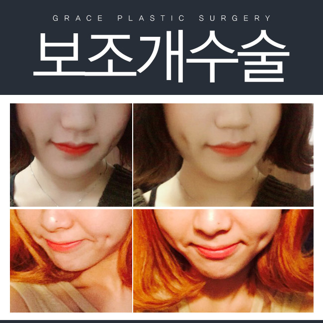예쁜 웃음의 포인트! 보조개수술 그레이스성형외과에서 관련 이미지 3