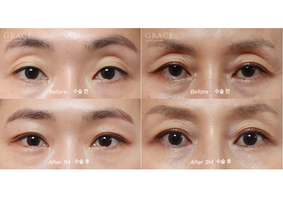 꺼진 눈두덩이 지방이식 잘하는 곳 유명한 이유가 있습니다. (칼럼) 관련 이미지 1