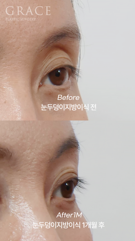 눈꺼풀 지방이식 보법이 다른 최문섭 원장님 실력 관련 이미지 7