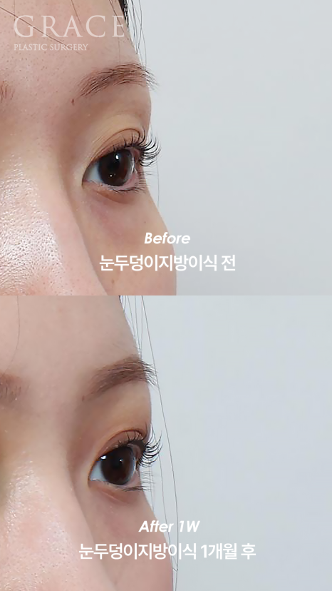 눈을 감았을 때 보이는 멍·흉터·울퉁불퉁함 걱정되나요? 눈두덩이 지방이식 관련 이미지 8