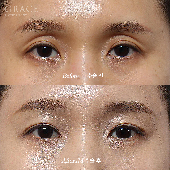 The Key to Improving Sunken Eyelids with Orbital Fat Grafting Is Placement, Not Volume image 1