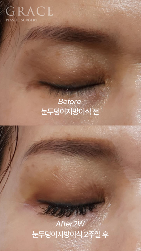 Concerns About Swelling and Side Effects After “Eye Hollow Fat Grafting” Surgery in the Eye Socket Area for People in Their 60s image 3