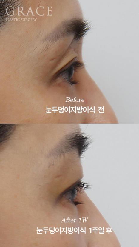 눈두덩이 부위에 절개해서 지방을 넣는다? 그레이스성형외과 아이홀 지방이식 방식에 대한 오해 관련 이미지 5