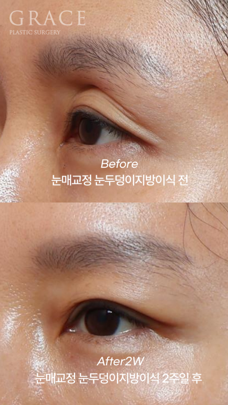 2-Week Swelling Progress After Upper Eyelid Fat Grafting + Incisional Ptosis Correction in Your 40s image 3
