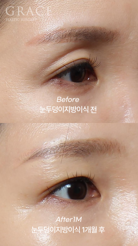 눈두덩이 지방이식 잘하는 병원? 의사 손에서 시작된다. 관련 이미지 4