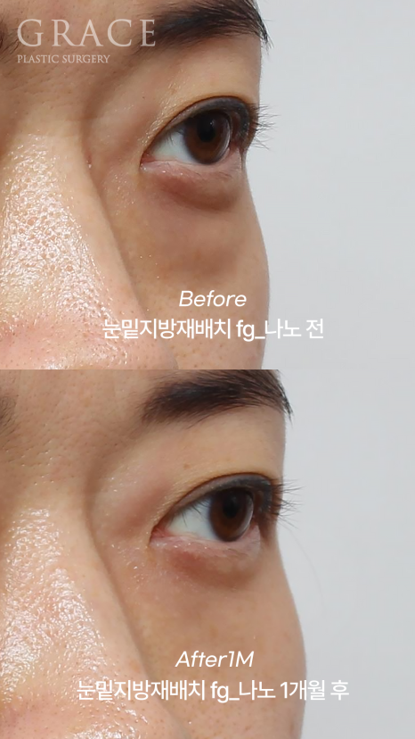눈밑지방재배치 vs 눈두덩이지방이식｜부작용과 붓기 등 관련 이미지 3